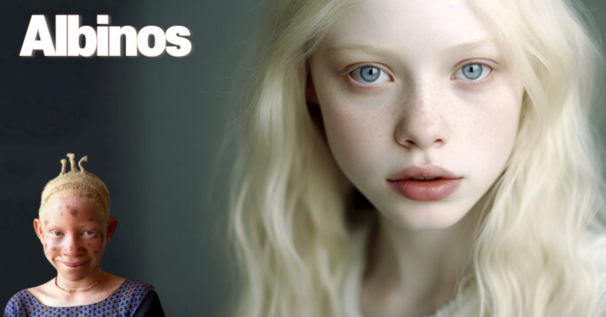 You are currently viewing 알비노 수명은(albinism lifespan) 40세? 전격 해부